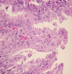 Cryptosporidiosis